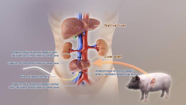 全球首例！中國團(tuán)隊(duì)成功將基因編輯豬肝臟移植人體