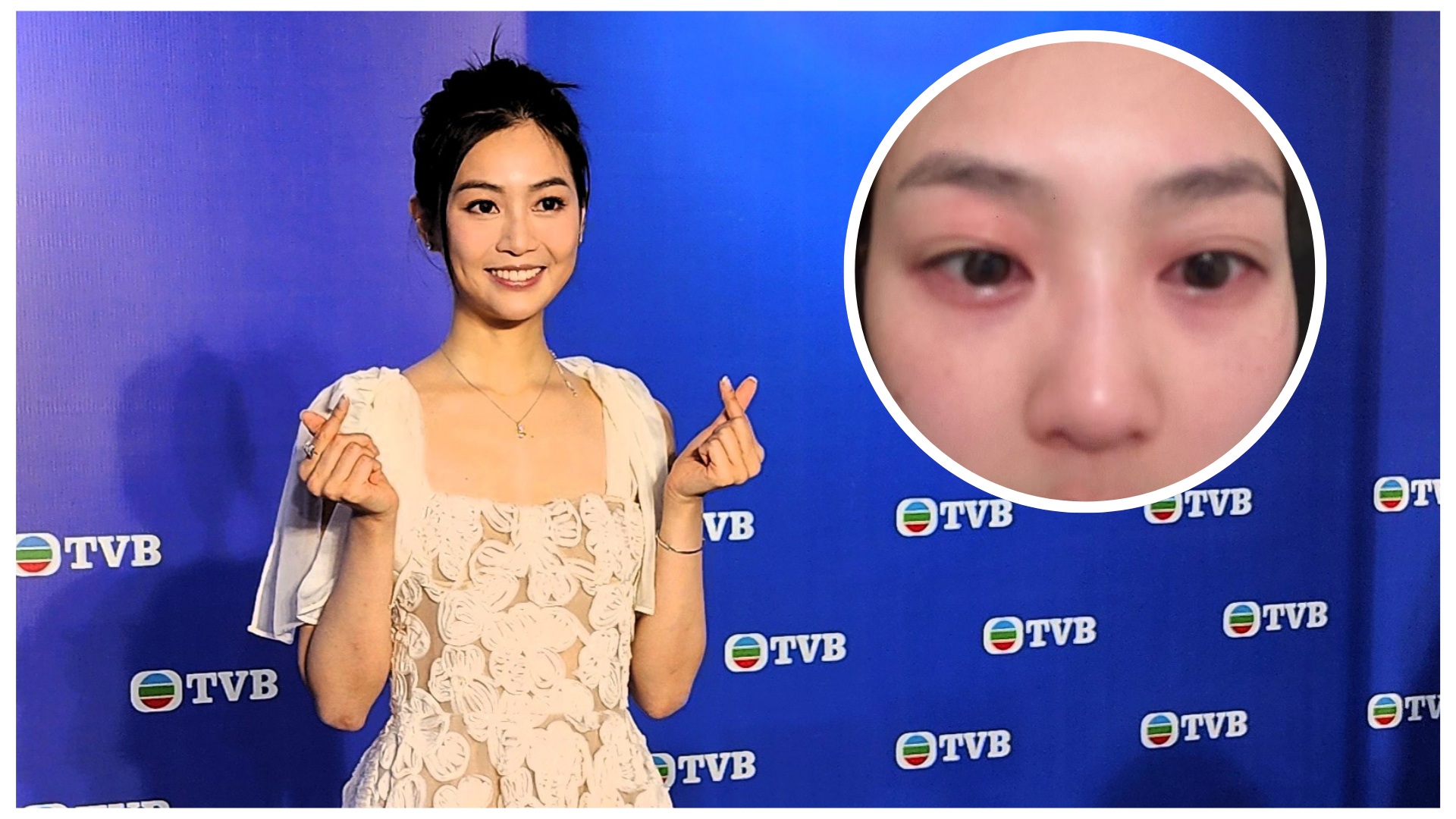 有片 | 【娛樂】郭柏妍回應(yīng)食物敏感引致眼腫呼吸困難緊急入院：當(dāng)時有想過死亡